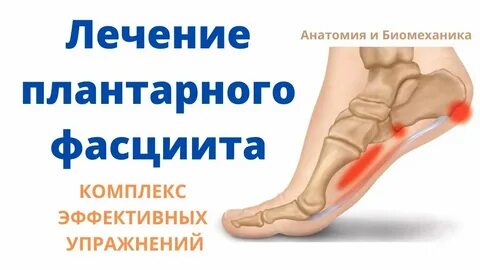 Плантарный фасциит стопы как лечить
