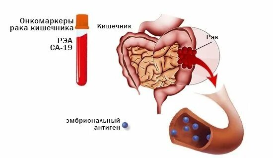 Механизм действия Раково-эмбриональный антигена. Опухолевые маркеры РЭА. Маркеры опухоли кишечника. Какой сдать онкомаркер кишечника