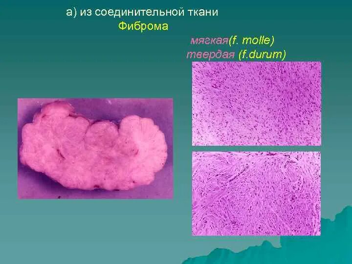 Соединительнотканные опухоли. Доброкачественные соединительнотканные опухоли. Опухоли из соединительной ткани. Фиброма соединительной ткани. Злокачественная опухоль из соединительной