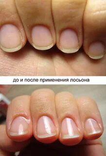 Лосьон для ногтей при онихолизисе