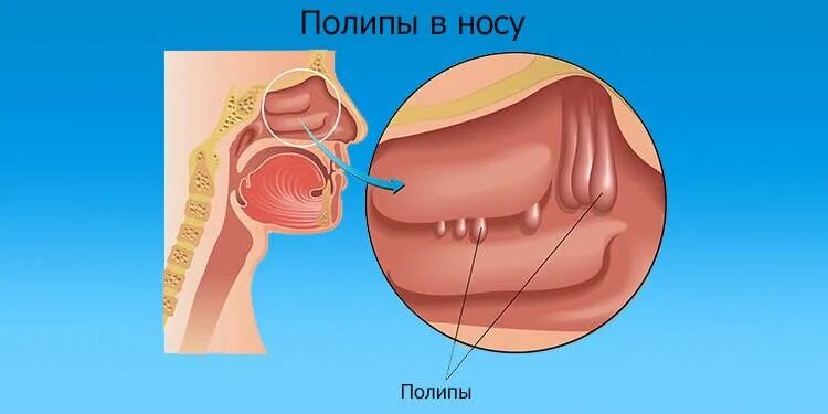 Sơ lược về giải phẫu & tâm sinh lý mũi Giải phẫu mũi: gồm có tháp mũi & hốc mũi.