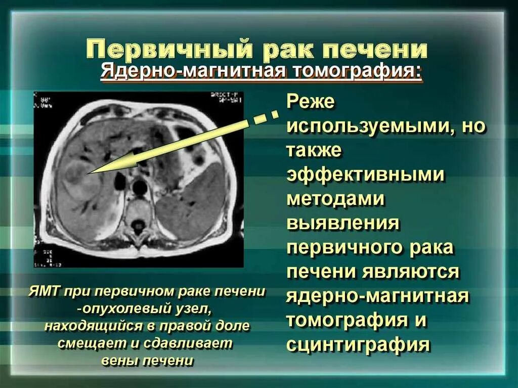 Признаки метастаз при раке. Злокачественные поражения печени. Первичные опухоли печени. Первичная карцинома печени. Первичные злокачественные опухоли печени.