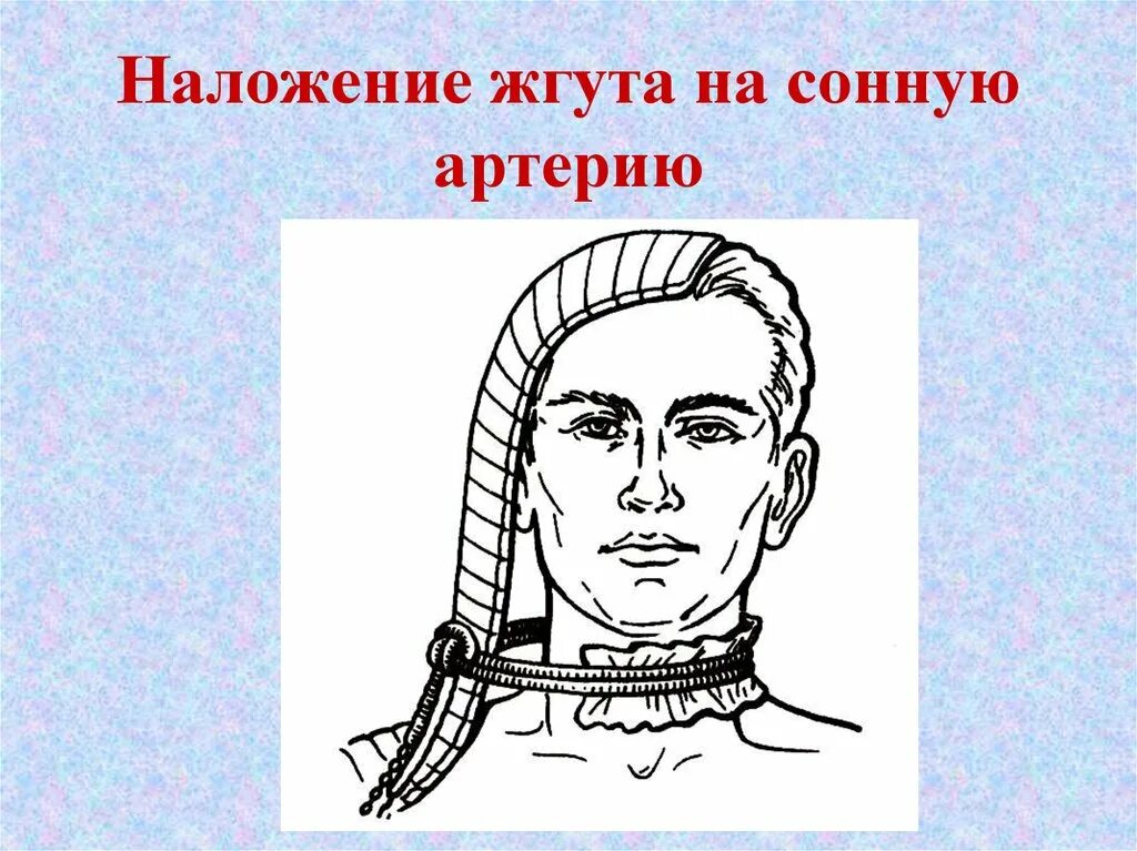 Остановить кровотечение на сонной артерии ответ тест. Наложение жгута на сонную артерию. Днут на соннуб артерию.