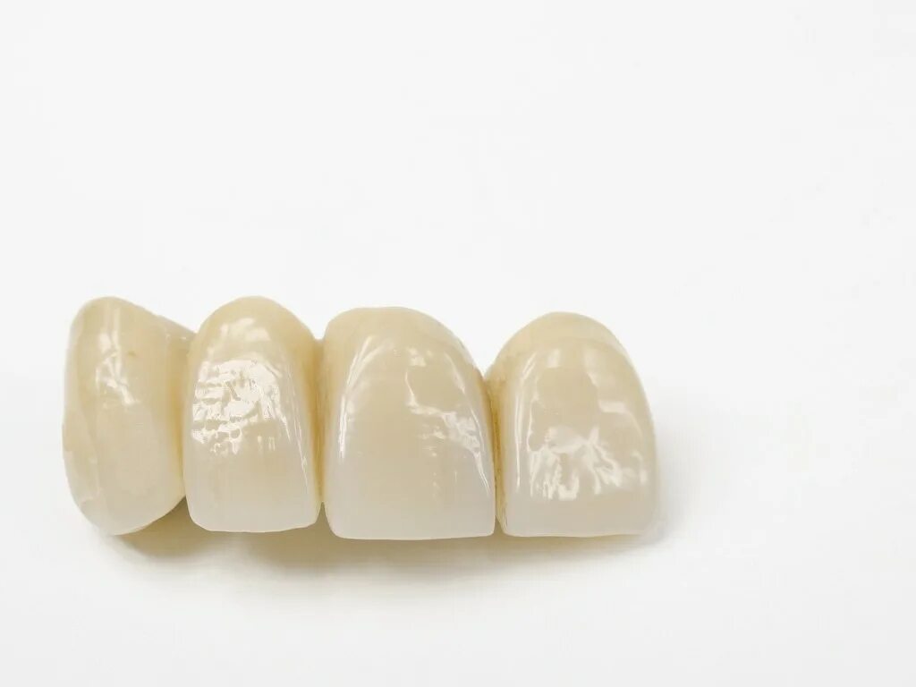 Временная пластмассовая коронка. Несъемный металлопластмассовый мостовидный протез. Пластмассовый мостовидный протез. Мостовидный протез на 1 зуб. Изготовление временного мостовидного протеза.