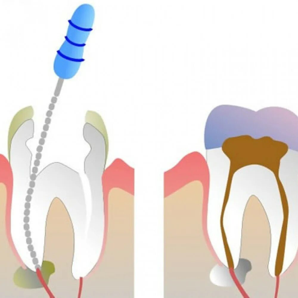 Распломбировка каналов зуба. Пульпита (депульпирование зуба. Депульпирование зуба (удаление нерва).