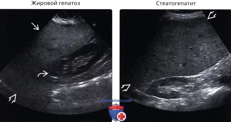 УЗИ печени при гепатомегалии. Жировой гепатоз печени на УЗИ. УЗИ признаки гепатомегалии.