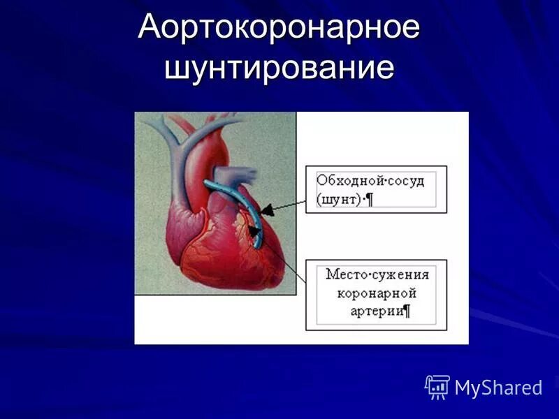 Что такое шунтирование при инфаркте. Что такое шунтирование при инфаркте