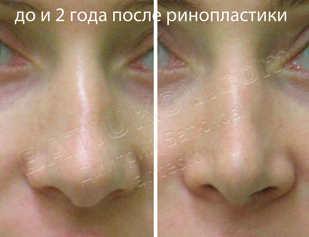 Ангионевротический отек диф диагноз. Через сколько времени проходит отек. Отёки серлачногл происхождения. Через сколько времени проходит отек. Через сколько времени проходит отек.