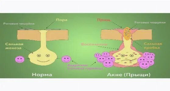 прыщи на лице какие гормоны сдавать