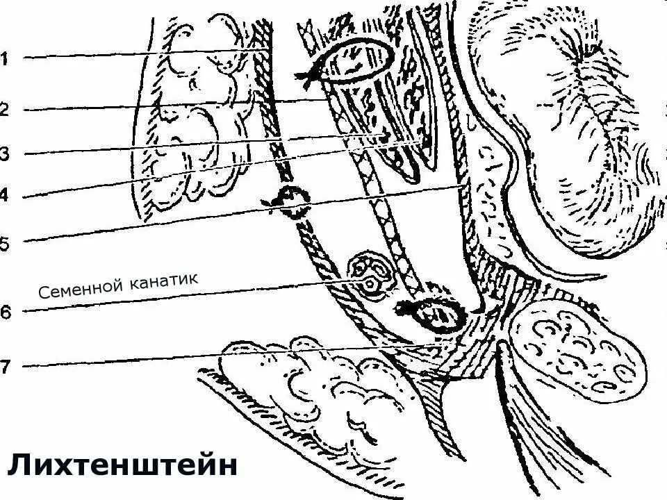 Пахового канала по Лихтенштейну. Блокада семенного канатика методика. Метод Лихтенштейна паховая грыжа. Пластика паховых грыж по Лихтенштейну. Лихтенштейн операция паховая