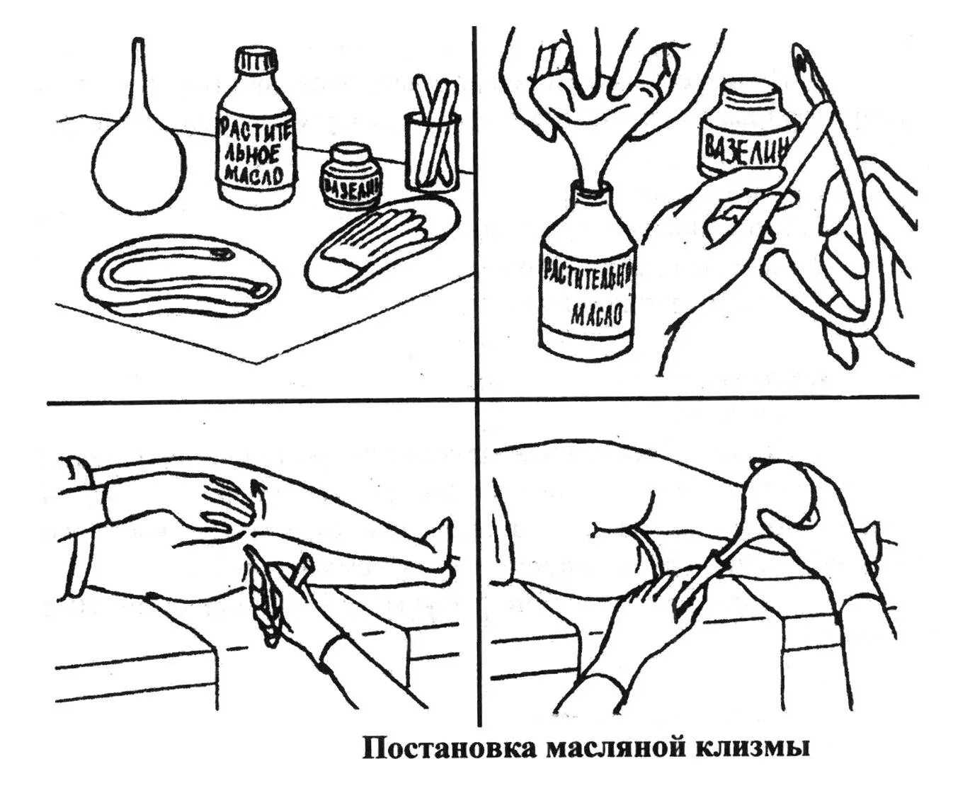 После масляной клизмы опорожнение наступает. Постановка послабляющей масляной клизмы. Техника постановки масляной клизмы. Масляная послабляющая клизма оснащение. Технику постановки масляной клизмы.