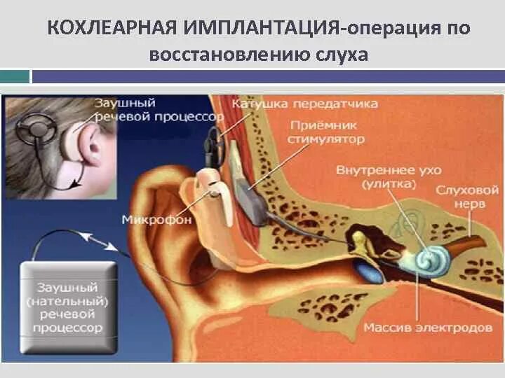 Восстановление слуха после