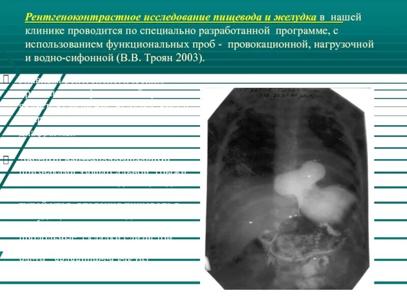 Водно сифонная проба желудка. Водная сифонная проба методика. Рентген желудка с водно-сифонной пробой. УЗИ ЖКТ С водно-сифонной пробой. УЗИ пищевода и желудка с водно сифонной пробой у детей.