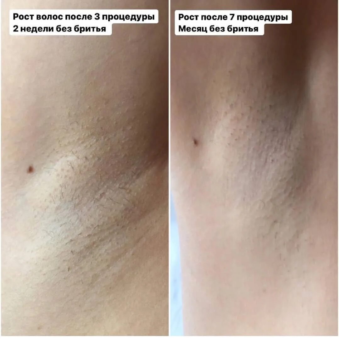 Когда начнут выпадать волосы после лазерной эпиляции. Лазерная эпиляция александритовым лазером до и после. Лазерная депиляция глубокое бикини. Лазерная эпиляция. Волосы после лазерной эпиляции.