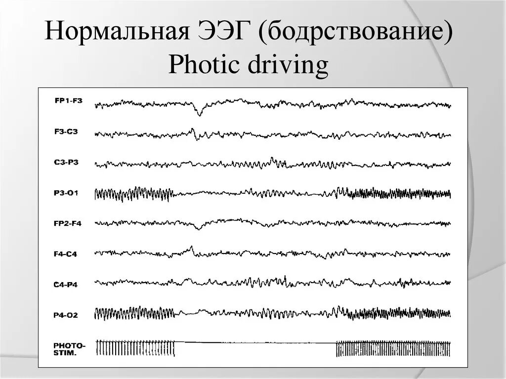 Нормальная ээг. ЭЭГ сигнал. Нормальное ЭЭГ бодрствующего. Нормальная ЭЭГ бодрствования. ЭЭГ В психиатрии.