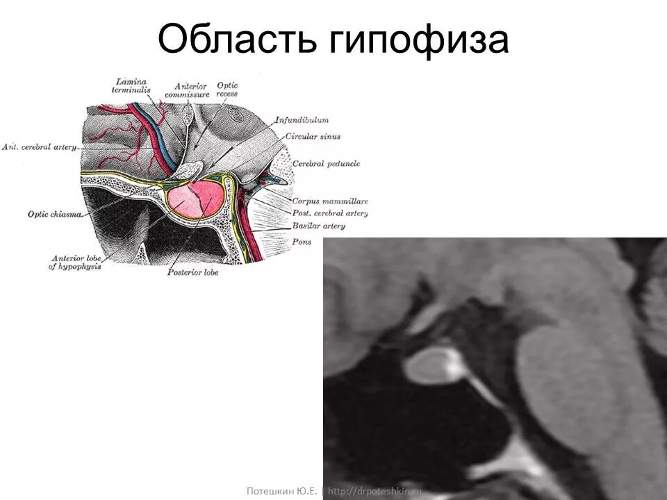 Изменения гипофизе. Эндосупраселлярная аденома гипофиза. Кт анатомия гипофиза. Строение гипофиза мрт. Образование гипофиза на кт.