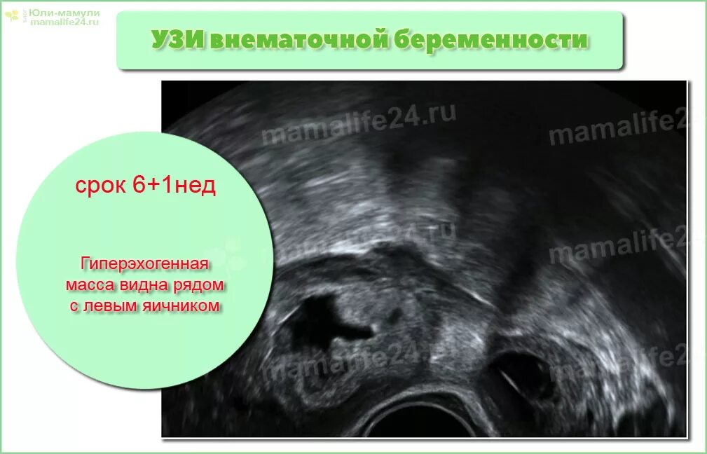 Внематочная беременность на УЗИ. УЗИ внематочной беременности на раннем сроке. Трубная беременность УЗИ. Внематочную беременность видно на УЗИ.