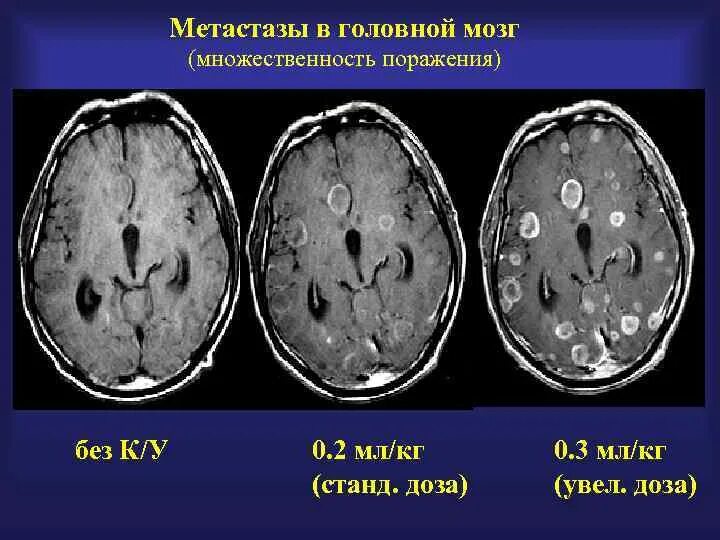 Метастазы меланомы в головной мозг кт. Кт признаки метастазов в головном мозге. Метастазы меланомы в головной мозг мрт.