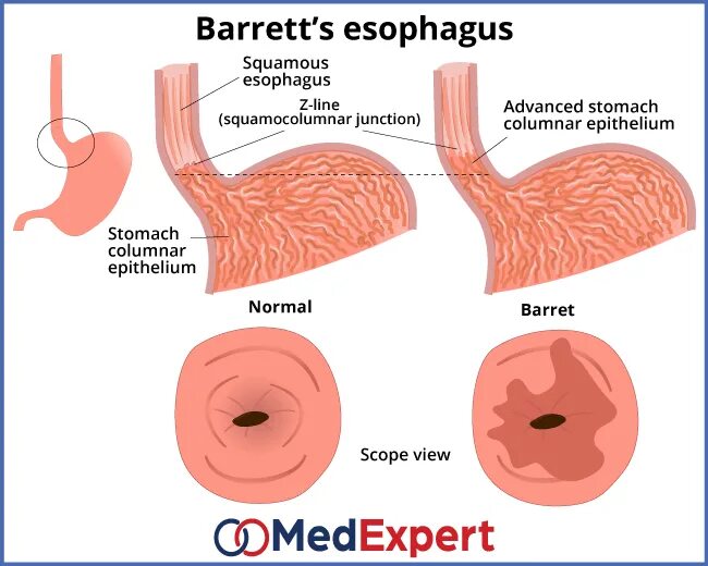 Пищевод барретта отзывы. Пищевод Барретта классификация. Пищевод Барретта эндоскопическая классификация. Классификация пищевода Барретта эндоскопия. Пищевод Барретта макро и микро.
