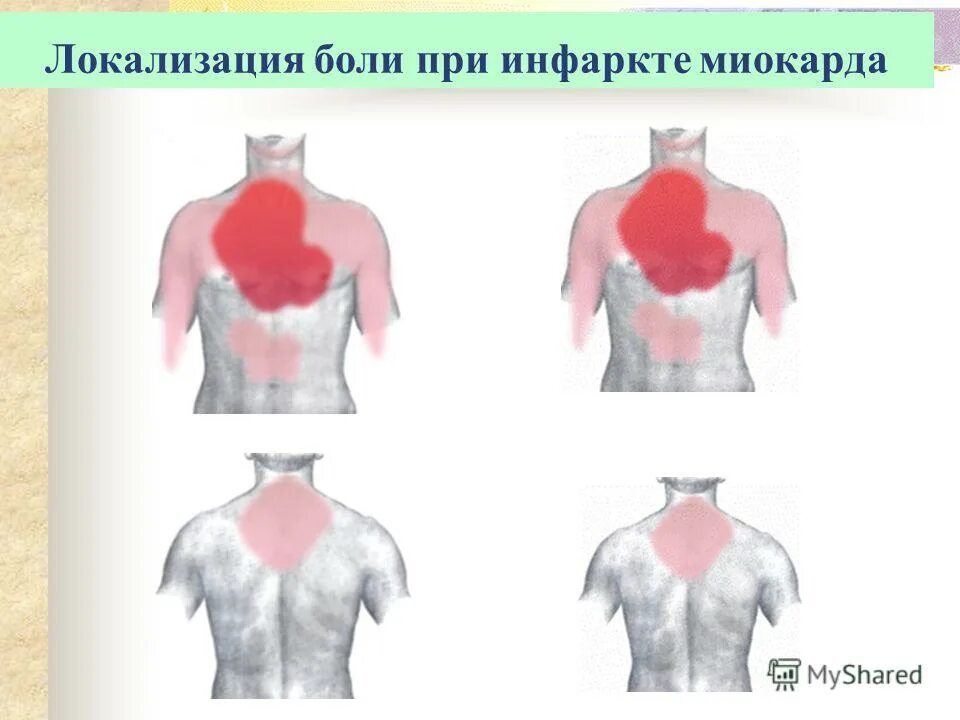 Иррадиация боли при инфаркте миокарда. Зоны иррадиации боли при инфаркте. Болевые зоны при инфаркте миокарда. Инфаркт миокарда локализация боли. Заболевания локализация боли