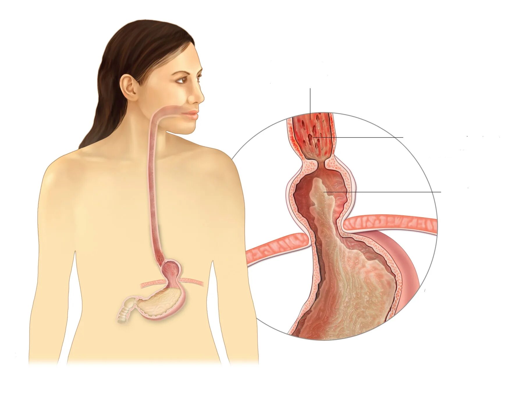 Грыжа эзофагит пищеводного. Гастроэзофагеальный рефлюкс гпод. Рефлюкс эзофагит патанатомия. Гэрб грыжа пищеводного отверстия диафрагмы. Грыжа эзофагит пищеводного.