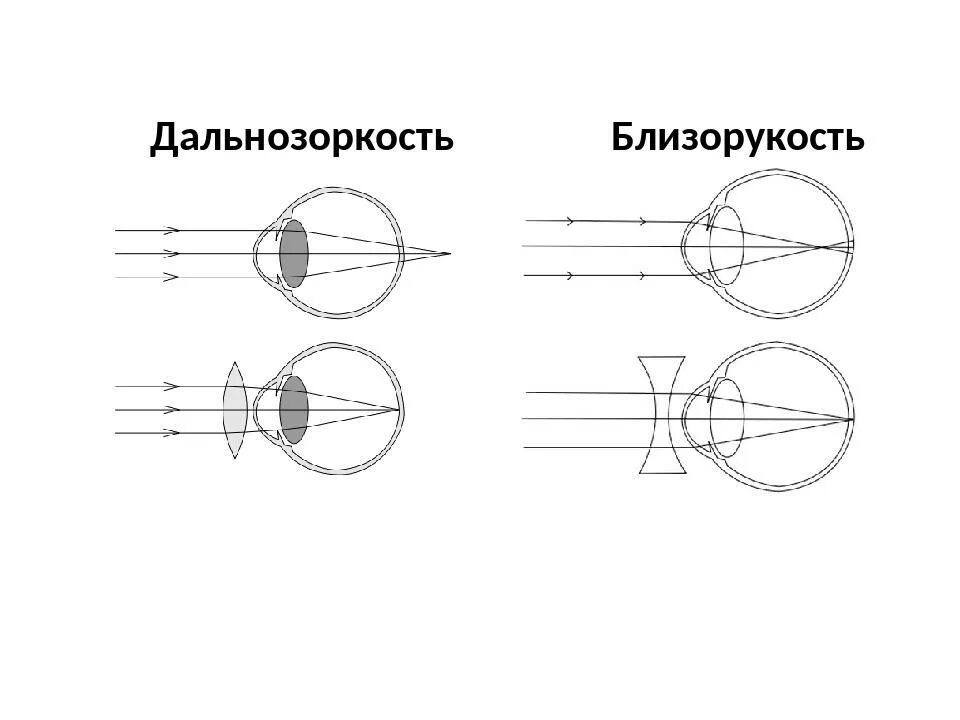 Коррекция зрения с помощью линз. Близорукость и дальнозоркость схема физика. Зрение схема близорукость и дальнозоркость. Миопия схема глаза. Чертежи близорукость и дальнозоркость.