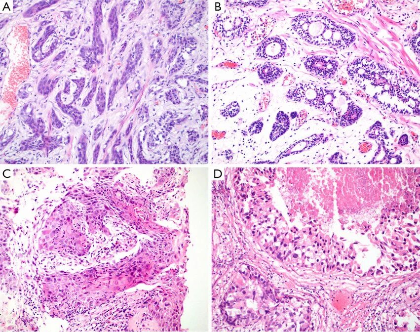 Тула простаты. Аденокарцинома предстательной железы гистология. Базальноклеточная карцинома гистология. Плоскоклеточная карцинома гистология. Крупноацинарная аденокарцинома предстательной железы гистология.