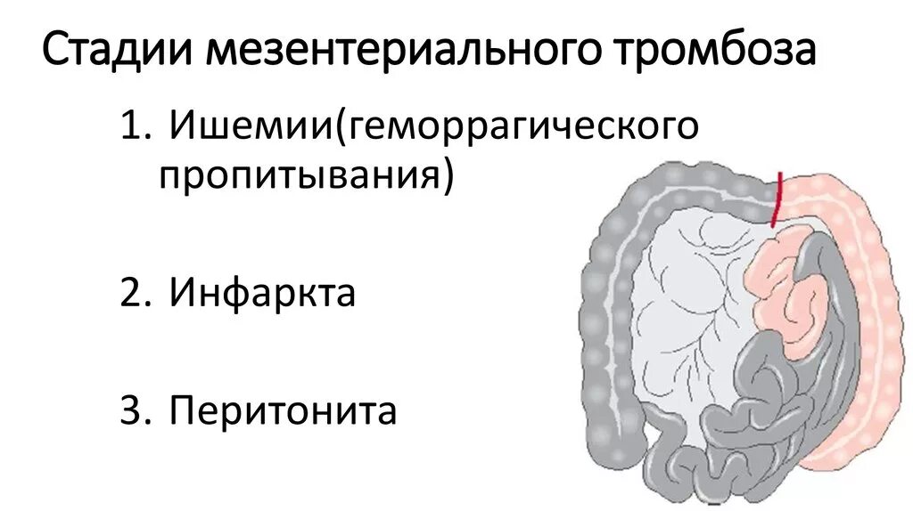 Мезентериальная ишемия. Тромбоз брыжеечных сосудов клиника. Острая окклюзия мезентериальных артерий. Тромбоз мезентериальных артерий. Тромбоз мезентериальных сосудов на кт.