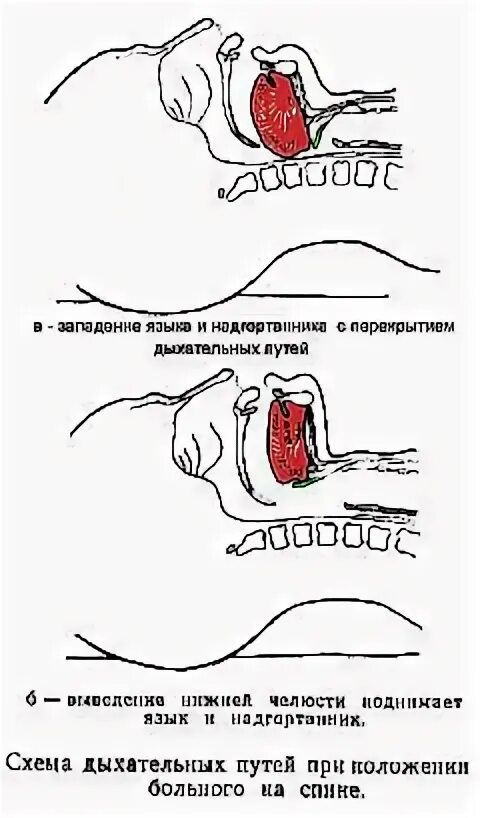 Западения корня языка. Первая помощь при западении языка. профилактика западения языка. западение языка причины.