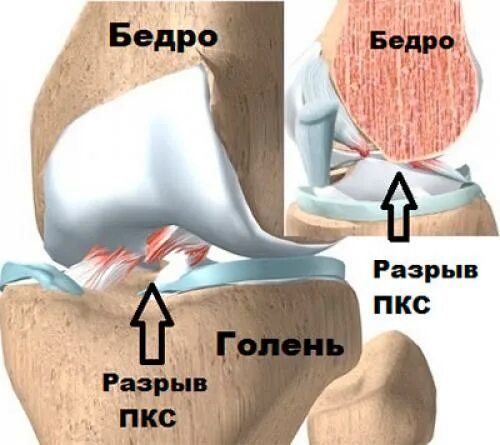 Парциальный разрыв крестообразной связки коленного сустава. Разрыв передней крестообразной связки (ПКС). Субтотальный разрыв крестообразной связки. Субтотального крестообразная связка коленного сустава. Полный разрыв передней крестообразной