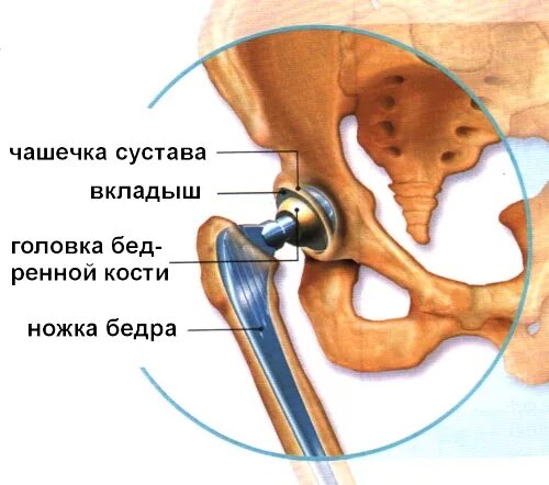 Замена тазобедренного сустава как проходит операция. Эндопротез тазобедренного сустава строение. Операция эндопротезирование тазобедренного сустава схема. Эндопротез кости бедра. Эндопротезирование тазобедренного сустава тотальное (схема 2).