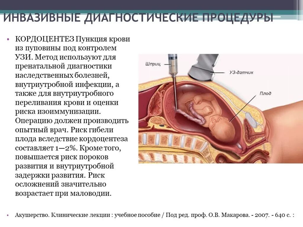 Трансабдоминальный кордоцентез. Кордоцентез инвазивная процедура. Пренатальная диагностика кордоцентез. Инвазивная пренатальная диагностика амниоцентез. Осложнения после пункции