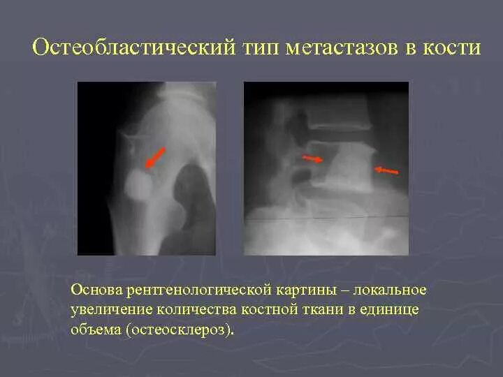 Очаговые изменения костей