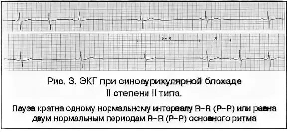 Блокада код по мкб 10. Синоатриальная блокада 1 степени на ЭКГ. ЭКГ при синоатриальной блокаде 3 степени. Синоатриальная блокада 2 степени на ЭКГ. Синоатриальная блокада 2 степени 1 типа на ЭКГ.