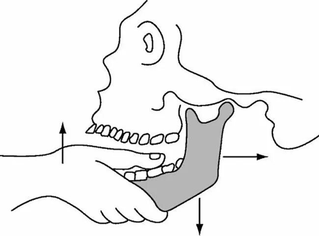 Подвижное соединение челюстей. Вывих височно-нижнечелюстного сочленения (вывих нижней челюсти). Методика вправления вывиха нижней челюсти.
