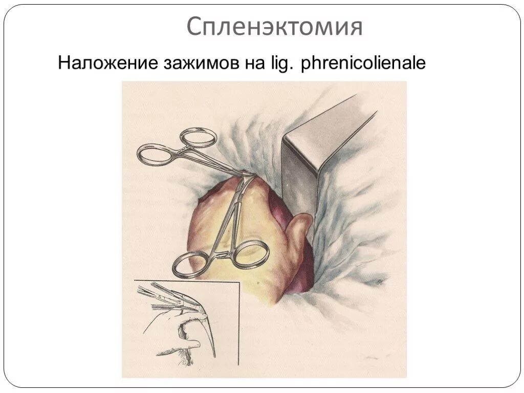 Спленэктомия что это. Этапы операции спленэктомии. Спленэктомия операция. Оперативное вмешательство спленэктомия.