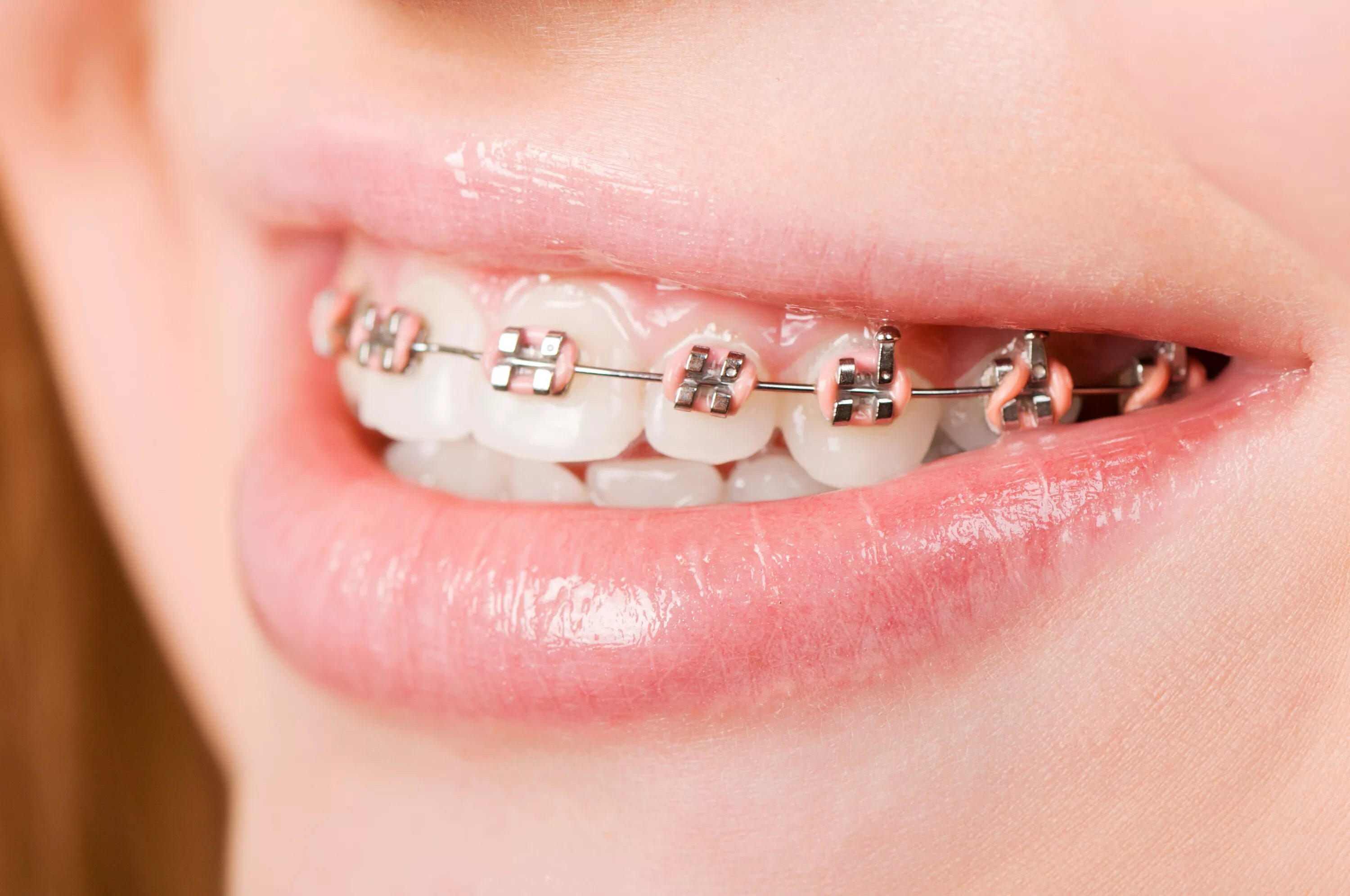 Easy brackets