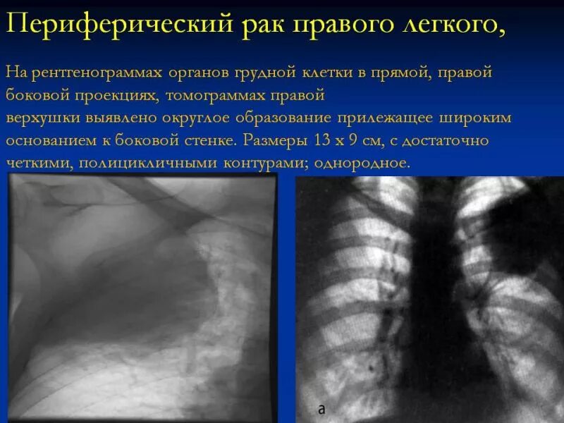 Периферическое образование левого легкого. Переферический очаг правого легкого. Периферическое образование легкого. Центральное образование правого легкого. Периферическое образование в легких что это.