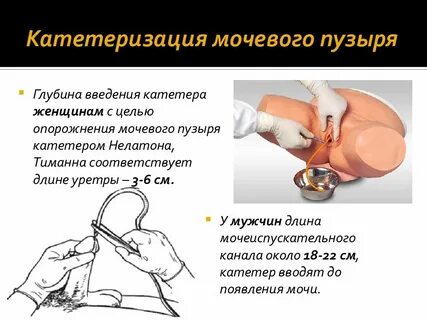 Как ставить катетер в мочевой пузырь женщинам схема