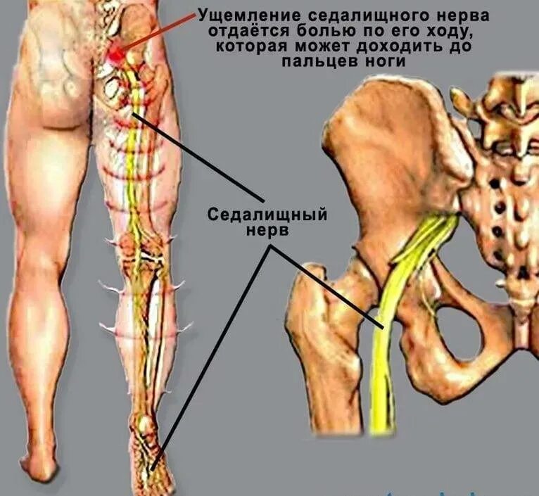 Седалищный нерв в ягодице фото