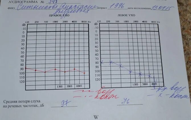 Тугоухость какая инвалидность. Аудиограмма 4 степени тугоухости. Аудиограмма 2 степени тугоухости. Тугоухость 4 степени у детей аудиограмма. Аудиограмма слуха 3 степени.