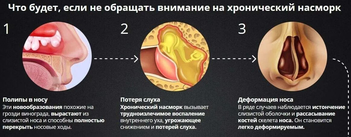 Почему часто воспаляется. Носовые раковины при аллергическом рините. Хронический насморк причины.