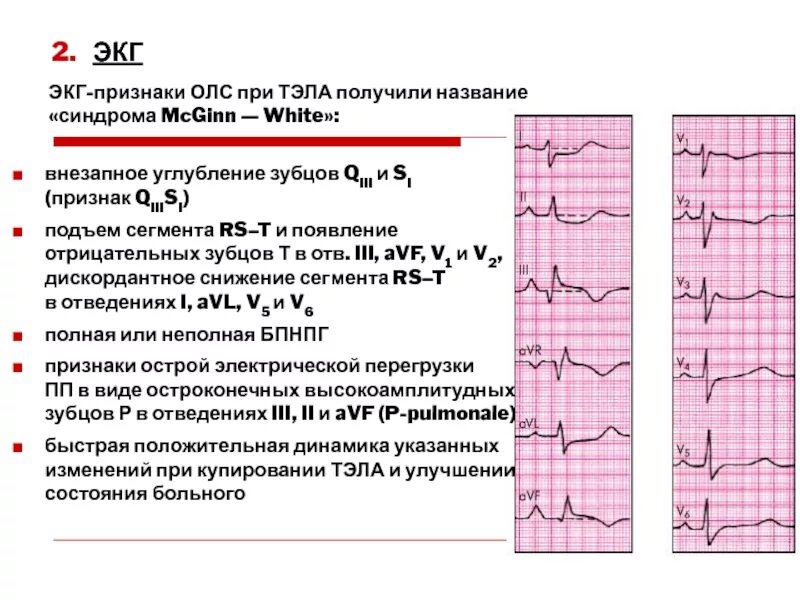 Синусовый ритм изменения миокарда