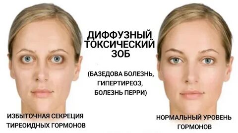 Глаза при щитовидной железе
