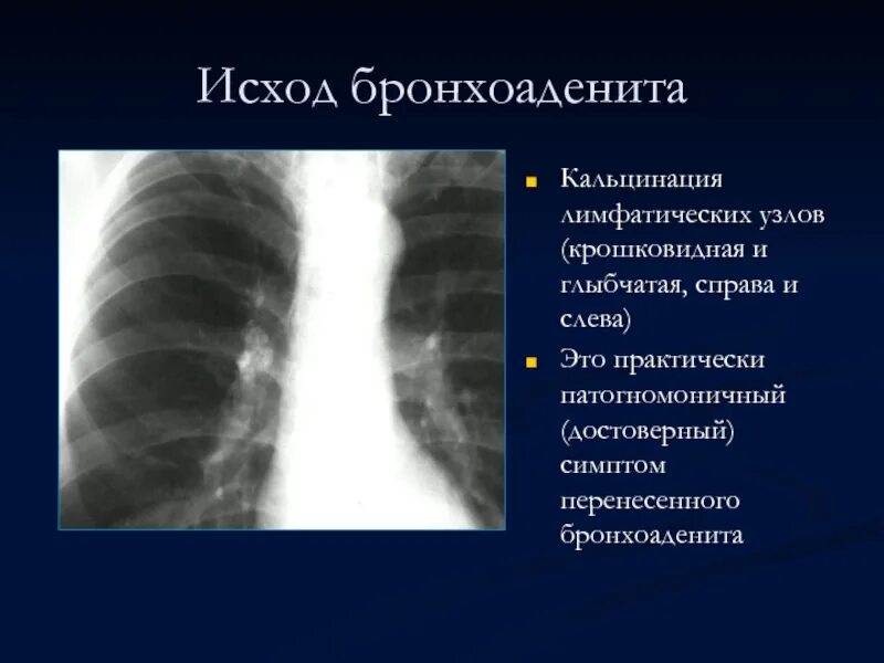 Туберкулезный бронхоаденит кт. Туберкулез лимфатических узлов рентген. Инфильтративный бронхоаденит рентген. Туберкулезный бронхоаденит симптомы. Кальцинаты в лимфоузлах