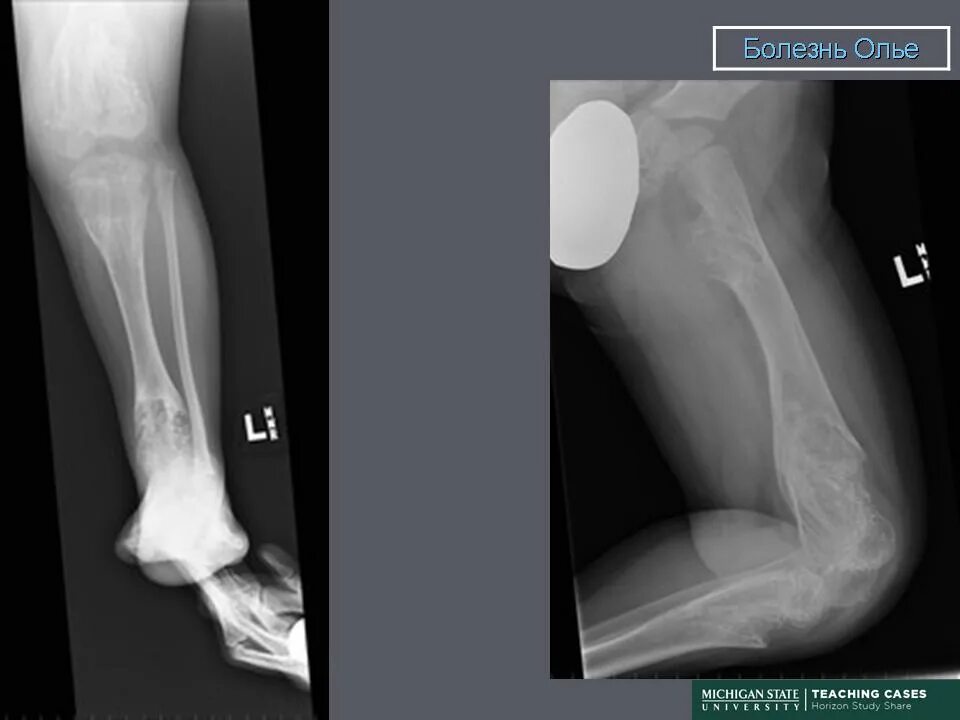 Болезнь олье. Болезнь олье. Болезнь олье рентген описание. Дисхондроплазия болезнь олье. Хондроматоз костей (болезнь оллье).