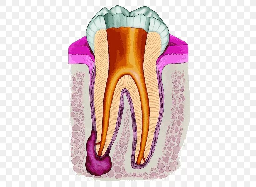 Зуб после простуды. Межкорневая гранулема. Корневая (радикулярная) киста. Радикулярная киста зуба.