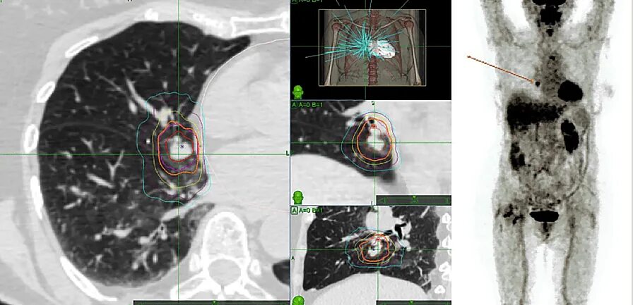 Figure 2 from Spinal dorsal dermal sinus tract: An experience of 21 cases Semant
