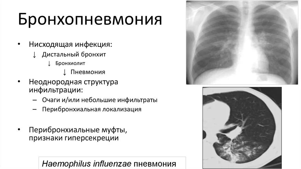 Бронхит заразен или. Бронхопневмония у детей рентген. Правосторонняя бронхопневмония рентген. Бронхопневмония и бронхиолит на кт. Бронхопневмония рентген протокол описания.