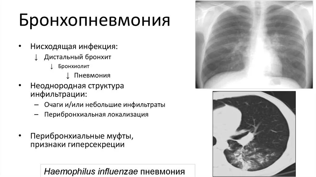 Сегментарная пневмония сколько лечится. Бронхопневмония у детей рентген. правосторонняя бронхопневмония рентген. перибронхиальная пневмония рентген. бронхопневмония и бронхиолит на кт.